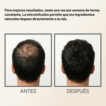 Elevo™ Sistema de Densificador Capilar